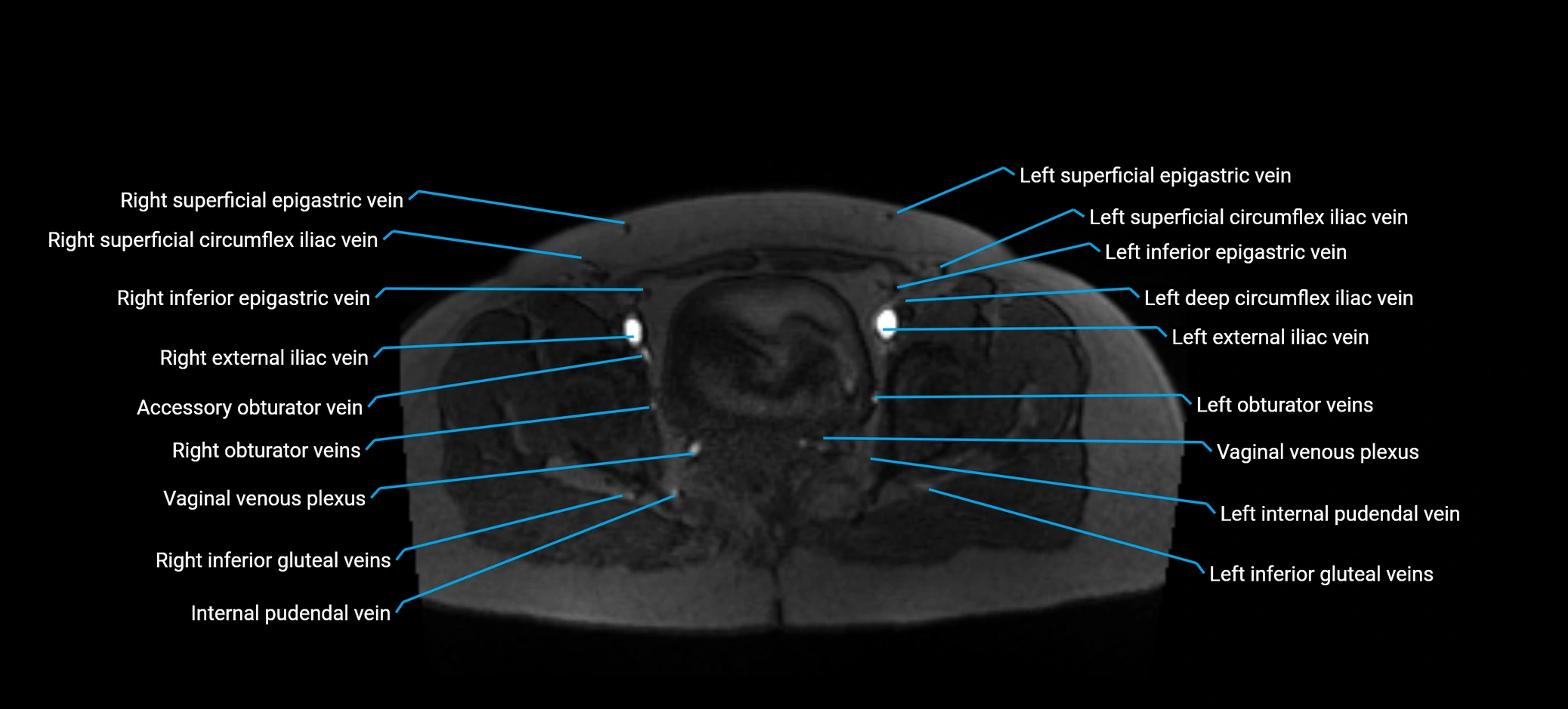 MRV abdomen pelvis & lower limb axial cross sectional anatomy labelled MRI image 175 (1).webp